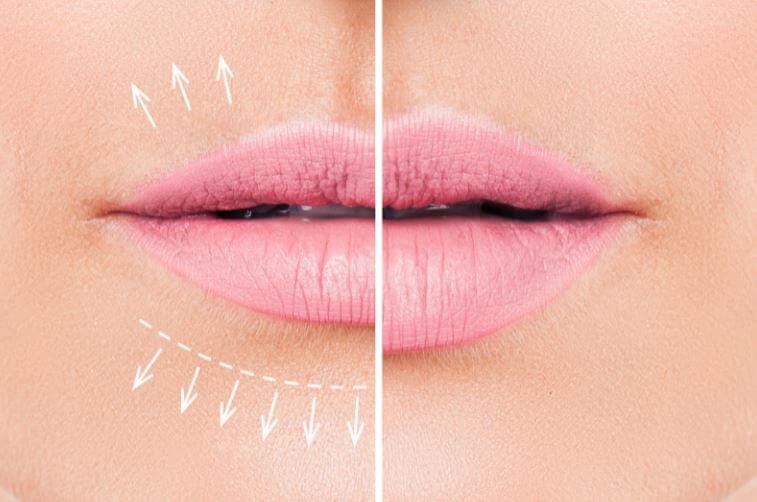 lips before and after injection