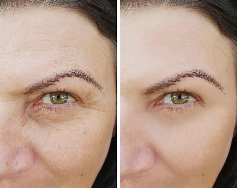 Anti-Wrinkle Injections